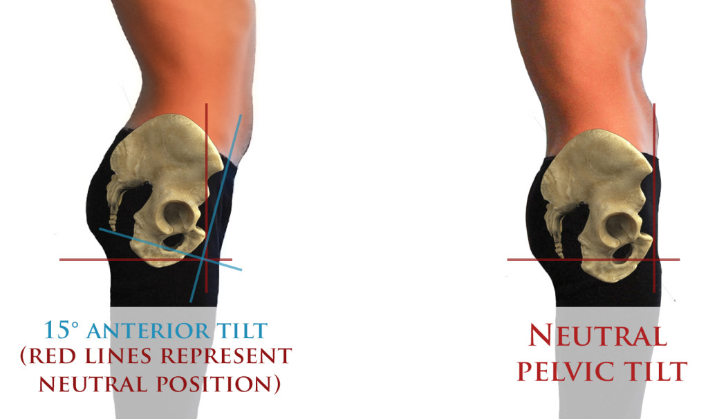 The lateral pelvic tilt : the degree of lateral pelvic tilt is
